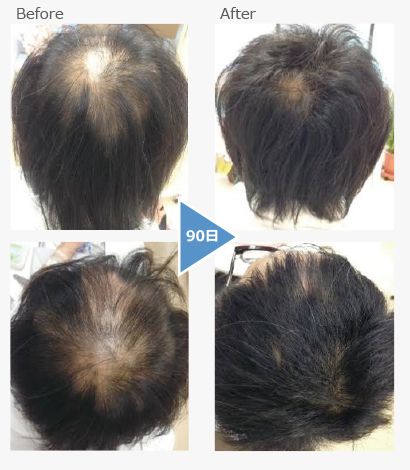 Chronic alopecia