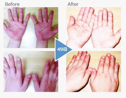 Dyshidrotic eczema