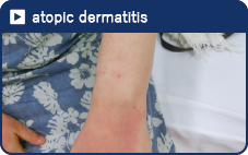 atopic dermatitis