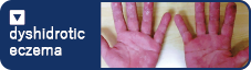 dyshidrotic eczema